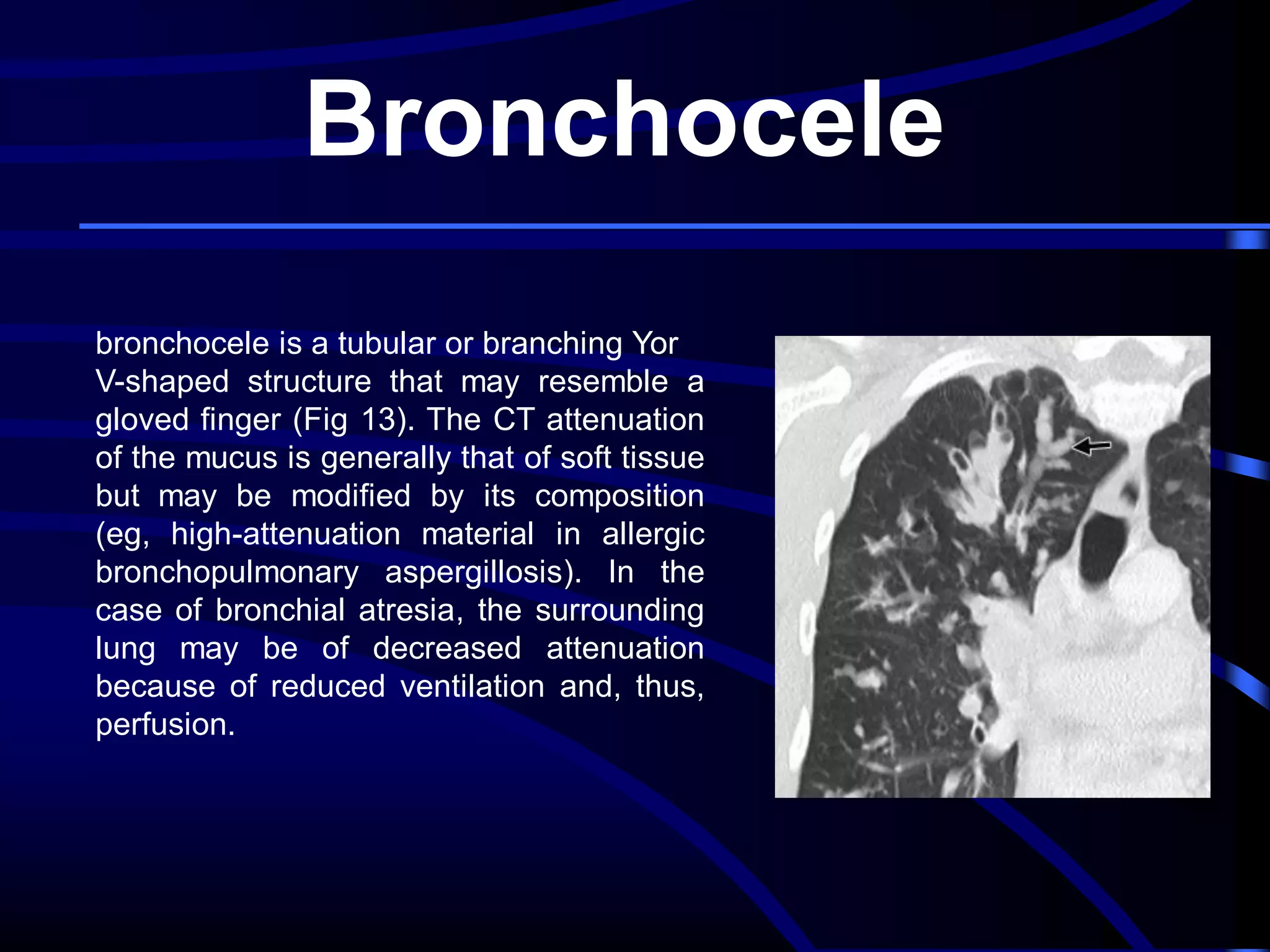 Bronchocele
bronchocele is a tubular or branching Yor
V-shaped structure that may resemble a
gloved finger (Fig 13). The CT attenuation
of the mucus is generally that of soft tissue
but may be modified by its composition
(eg, high-attenuation material in allergic
bronchopulmonary aspergillosis). In the
case of bronchial atresia, the surrounding
lung may be of decreased attenuation
because of reduced ventilation and, thus,
perfusion.

 