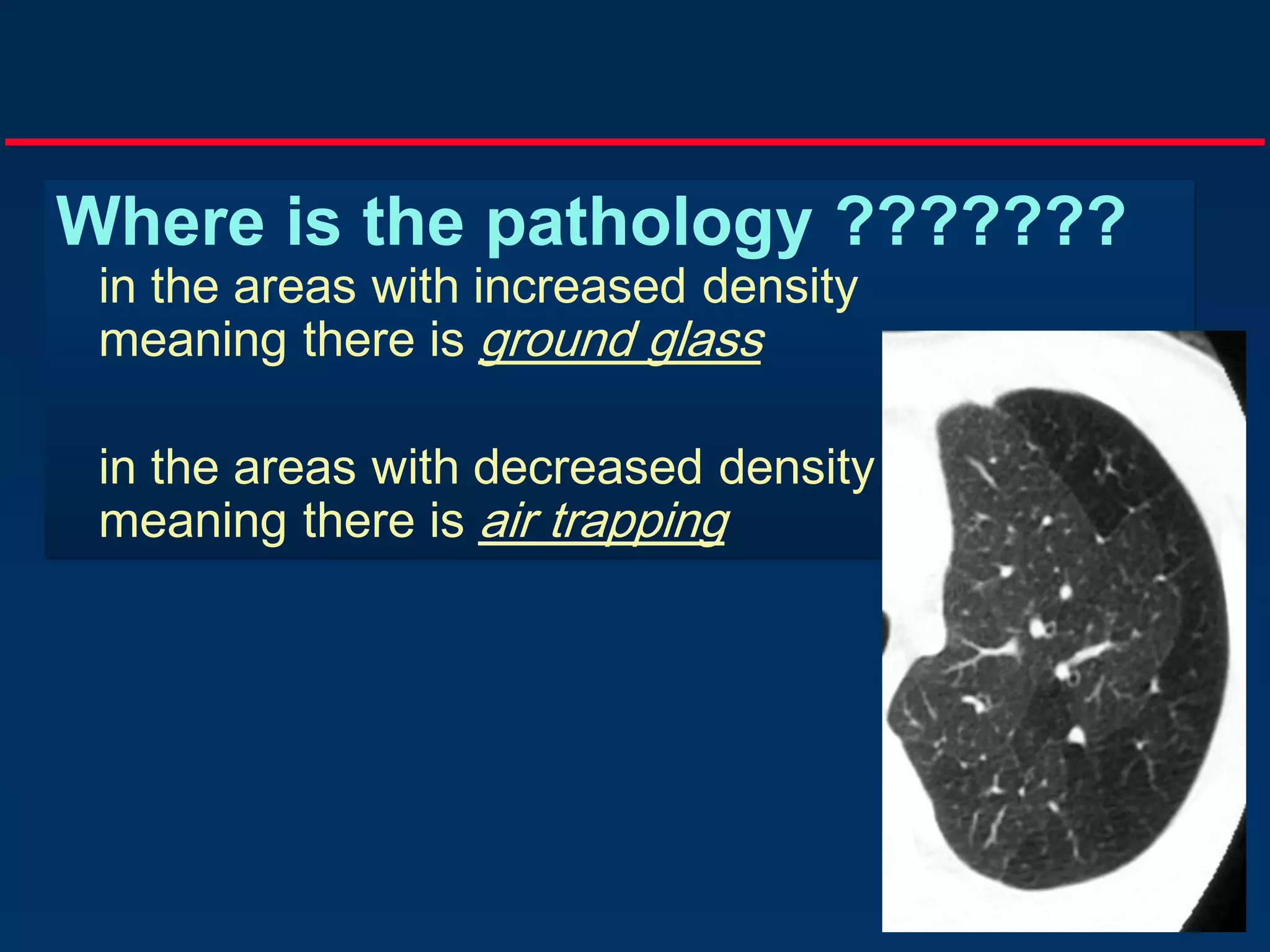 Where is the pathology ???????
in the areas with increased density
meaning there is ground glass
in the areas with decreased density
meaning there is air trapping

 