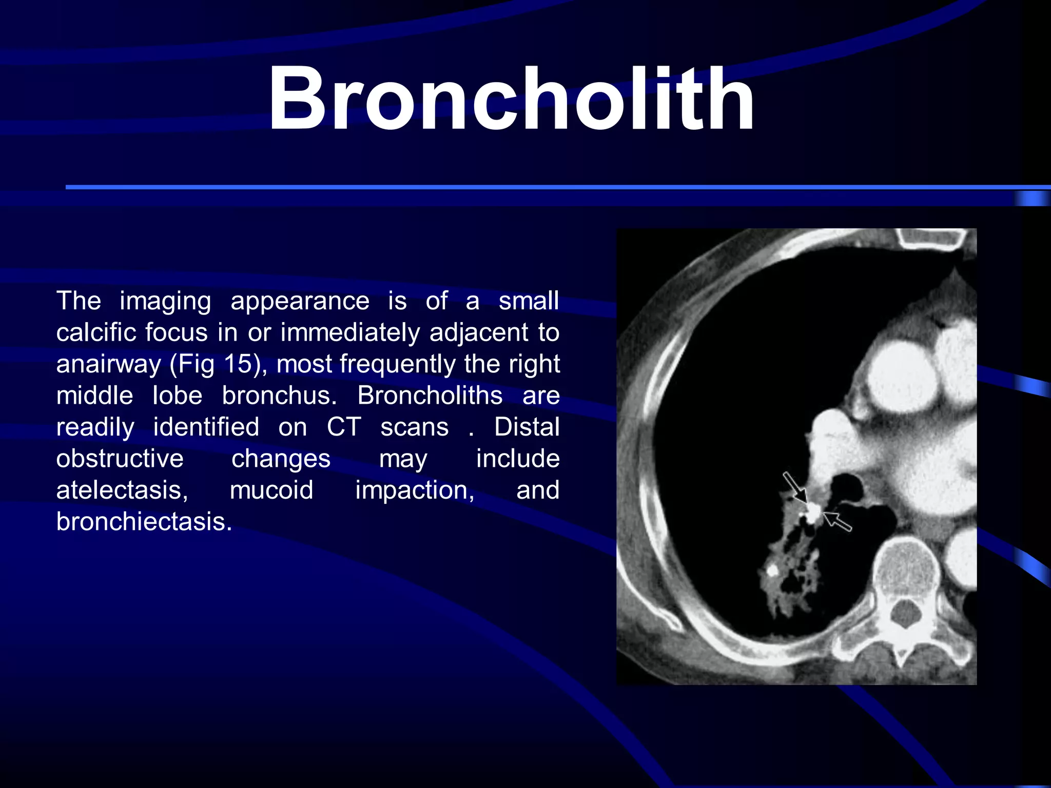 Broncholith
The imaging appearance is of a small
calcific focus in or immediately adjacent to
anairway (Fig 15), most frequently the right
middle lobe bronchus. Broncholiths are
readily identified on CT scans . Distal
obstructive
changes
may
include
atelectasis,
mucoid
impaction,
and
bronchiectasis.

 