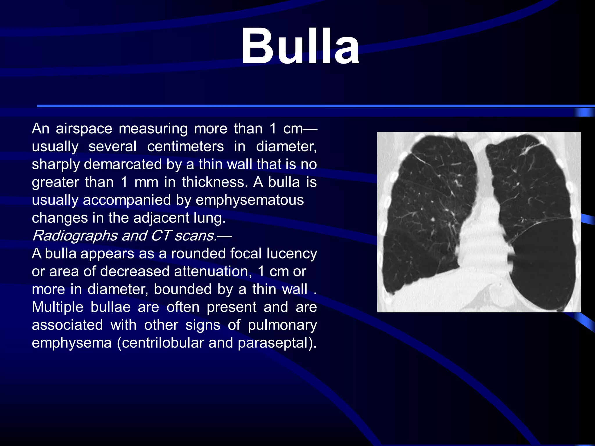 Bulla
An airspace measuring more than 1 cm—
usually several centimeters in diameter,
sharply demarcated by a thin wall that is no
greater than 1 mm in thickness. A bulla is
usually accompanied by emphysematous
changes in the adjacent lung.
Radiographs and CT scans.—
A bulla appears as a rounded focal lucency
or area of decreased attenuation, 1 cm or
more in diameter, bounded by a thin wall .
Multiple bullae are often present and are
associated with other signs of pulmonary
emphysema (centrilobular and paraseptal).

 