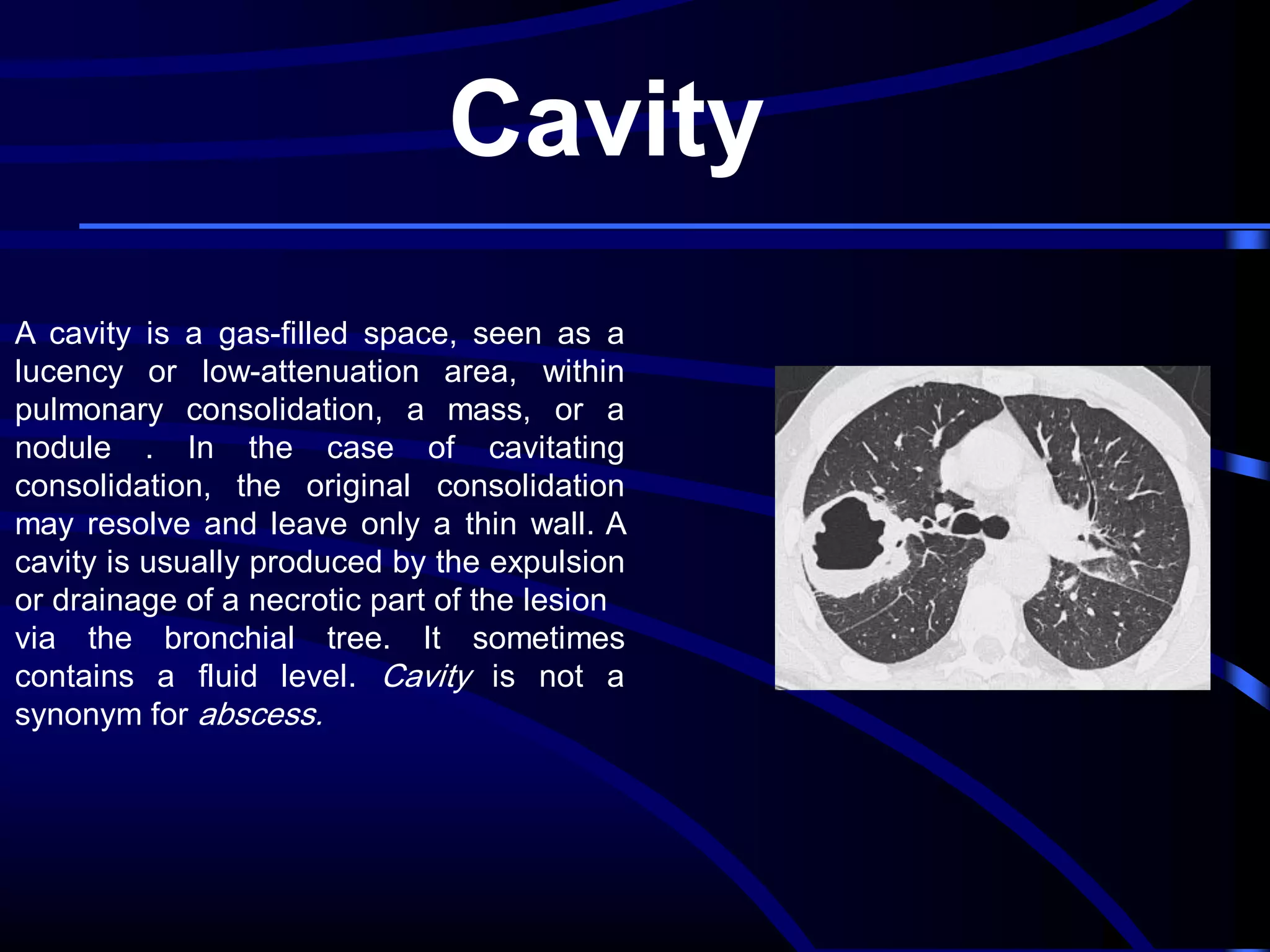 Cavity
A cavity is a gas-filled space, seen as a
lucency or low-attenuation area, within
pulmonary consolidation, a mass, or a
nodule . In the case of cavitating
consolidation, the original consolidation
may resolve and leave only a thin wall. A
cavity is usually produced by the expulsion
or drainage of a necrotic part of the lesion
via the bronchial tree. It sometimes
contains a fluid level. Cavity is not a
synonym for abscess.

 