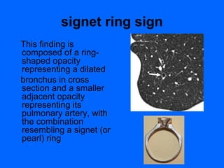 signet ring sign
This finding is
composed of a ring-
shaped opacity
representing a dilated
bronchus in cross
section and a smaller
adjacent opacity
representing its
pulmonary artery, with
the combination
resembling a signet (or
pearl) ring
 