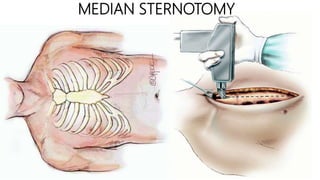 Thoracic inciscions | PPTX