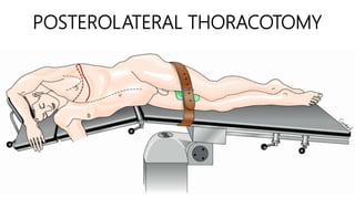 Thoracic inciscions | PPTX