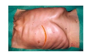 Thoracic inciscions | PPTX
