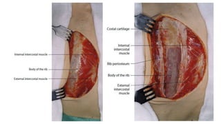 T Incision Classical Thoracic inciscions | PPTX