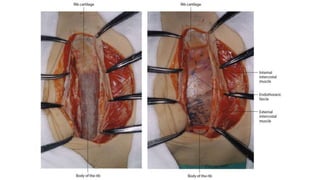 Thoracic inciscions | PPTX