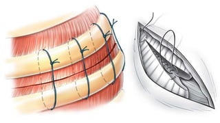 T Incision Classical Thoracic inciscions | PPTX