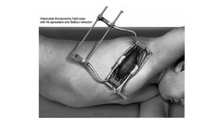 Thoracic inciscions | PPTX