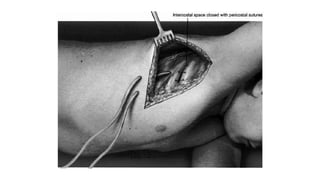 Thoracic inciscions | PPTX