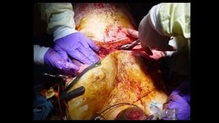 Thoracic inciscions | PPTX