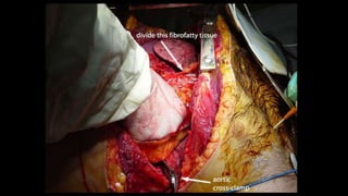 Thoracic inciscions | PPTX