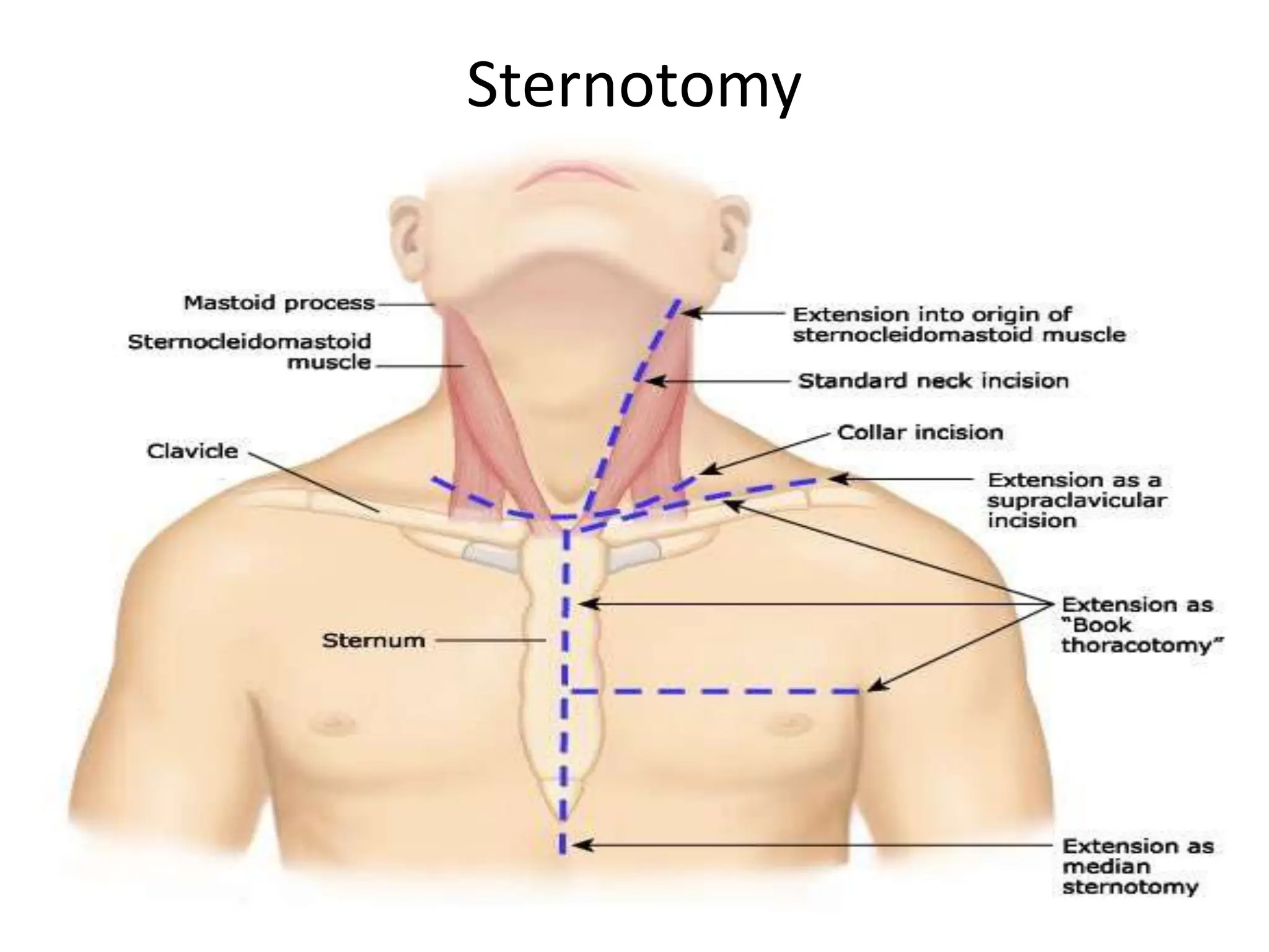 THORACIC INCISIONS a powerpoint for general surgeons | PPTX