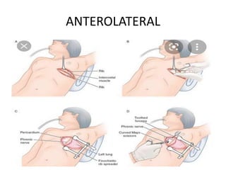 THORACIC INCISIONS a powerpoint for general surgeons | PPTX