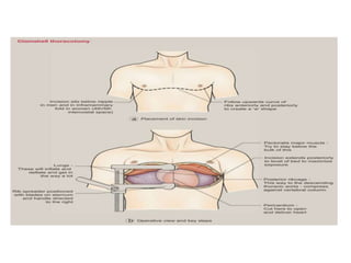 T Incision Classical THORACIC INCISIONS a powerpoint for general surgeons | PPTX