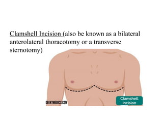 Thoracic Incisions & complications pdf.pdf