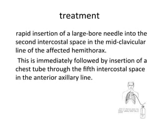 treatment
rapid insertion of a large-bore needle into the
second intercostal space in the mid-clavicular
line of the affected hemithorax.
This is immediately followed by insertion of a
chest tube through the ﬁfth intercostal space
in the anterior axillary line.

 