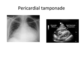 Pericardial tamponade

 