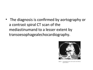 • The diagnosis is conﬁrmed by aortography or
a contrast spiral CT scan of the
mediastinumand to a lesser extent by
transoesophagealechocardiography.

 