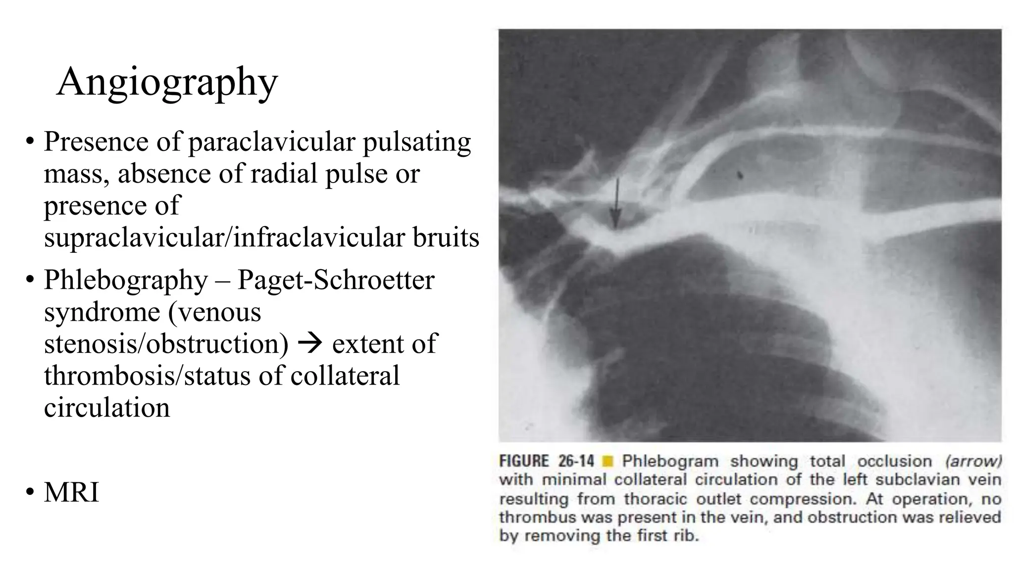 Thoracic outlet syndrome-1.pptx