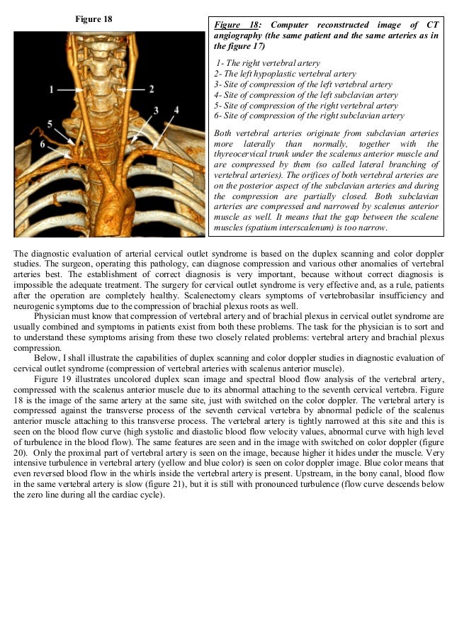 Thoracic Outlet Syndrome: Anatomy, Symptoms, Diagnostic Thoracic Outlet Syndrome: Anatomy, Symptoms, Diagnostic