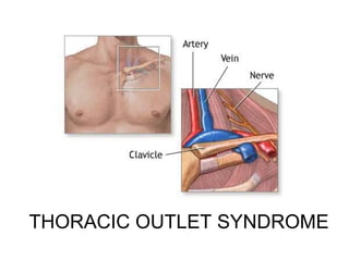 THORACIC OUTLET SYNDROME

 