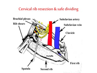Thoracic outlet syndrome | PPTX