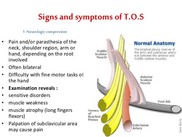 Thoracic outlet syndrome