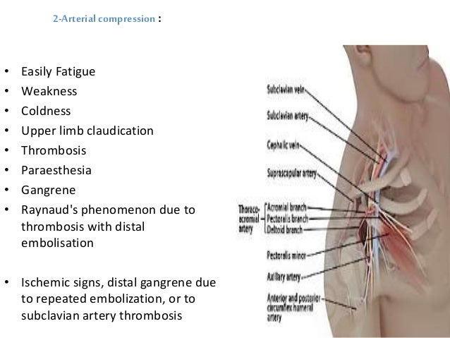 Thoracic outlet syndrome Thoracic outlet syndrome