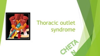 Thoracic outlet
syndrome
 