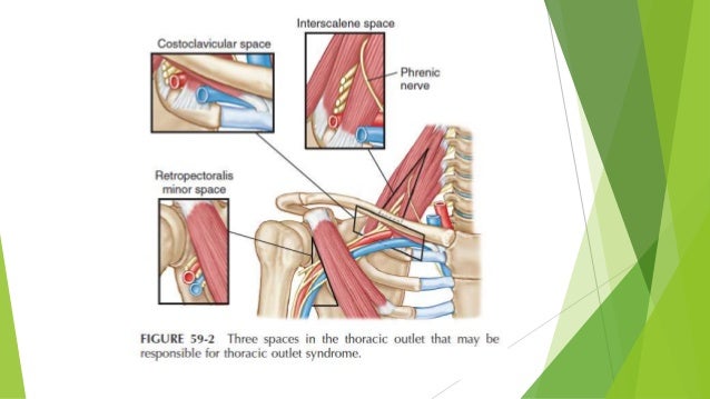 Thoracic outlet complications