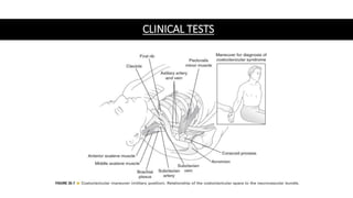 Thoracic outlet syndrome | PPTX