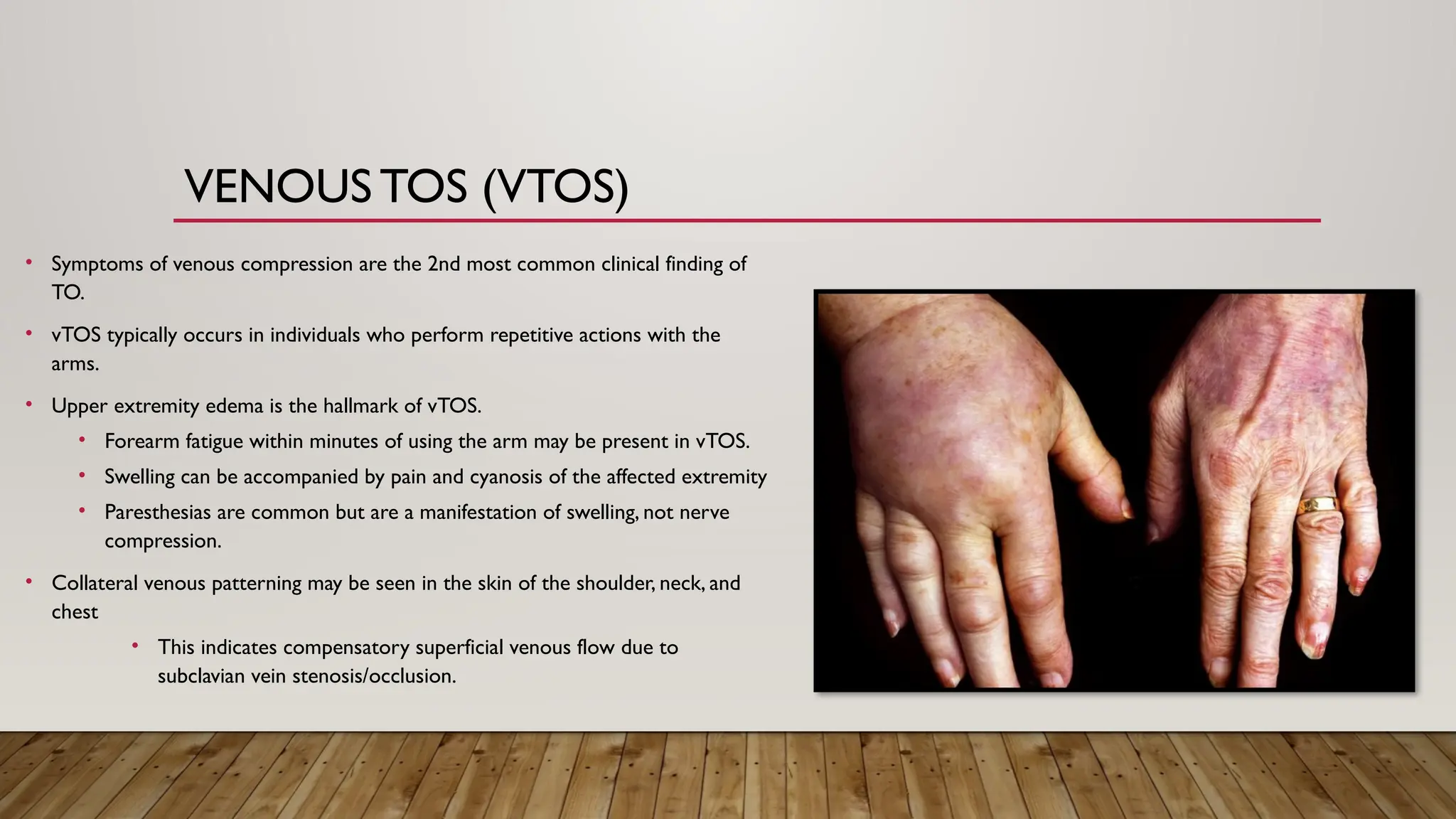 VENOUS TOS (VTOS)
• Symptoms of venous compression are the 2nd most common clinical finding of
TO.
• vTOS typically occurs in individuals who perform repetitive actions with the
arms.
• Upper extremity edema is the hallmark of vTOS.
• Forearm fatigue within minutes of using the arm may be present in vTOS.
• Swelling can be accompanied by pain and cyanosis of the affected extremity
• Paresthesias are common but are a manifestation of swelling, not nerve
compression.
• Collateral venous patterning may be seen in the skin of the shoulder, neck, and
chest
• This indicates compensatory superficial venous flow due to
subclavian vein stenosis/occlusion.
 