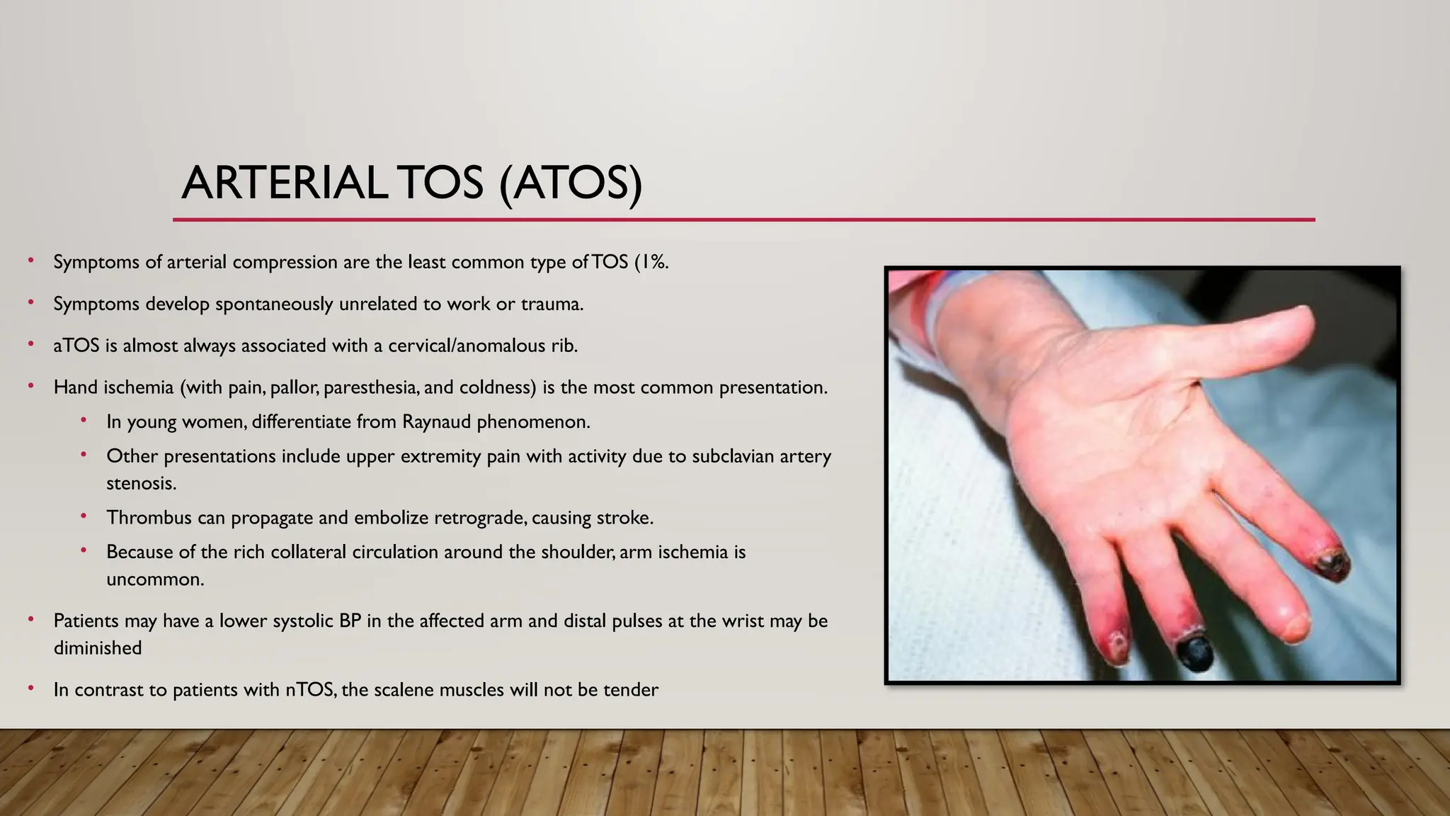 ARTERIAL TOS (ATOS)
• Symptoms of arterial compression are the least common type ofTOS (1%.
• Symptoms develop spontaneously unrelated to work or trauma.
• aTOS is almost always associated with a cervical/anomalous rib.
• Hand ischemia (with pain, pallor, paresthesia, and coldness) is the most common presentation.
• In young women, differentiate from Raynaud phenomenon.
• Other presentations include upper extremity pain with activity due to subclavian artery
stenosis.
• Thrombus can propagate and embolize retrograde, causing stroke.
• Because of the rich collateral circulation around the shoulder, arm ischemia is
uncommon.
• Patients may have a lower systolic BP in the affected arm and distal pulses at the wrist may be
diminished
• In contrast to patients with nTOS, the scalene muscles will not be tender
 