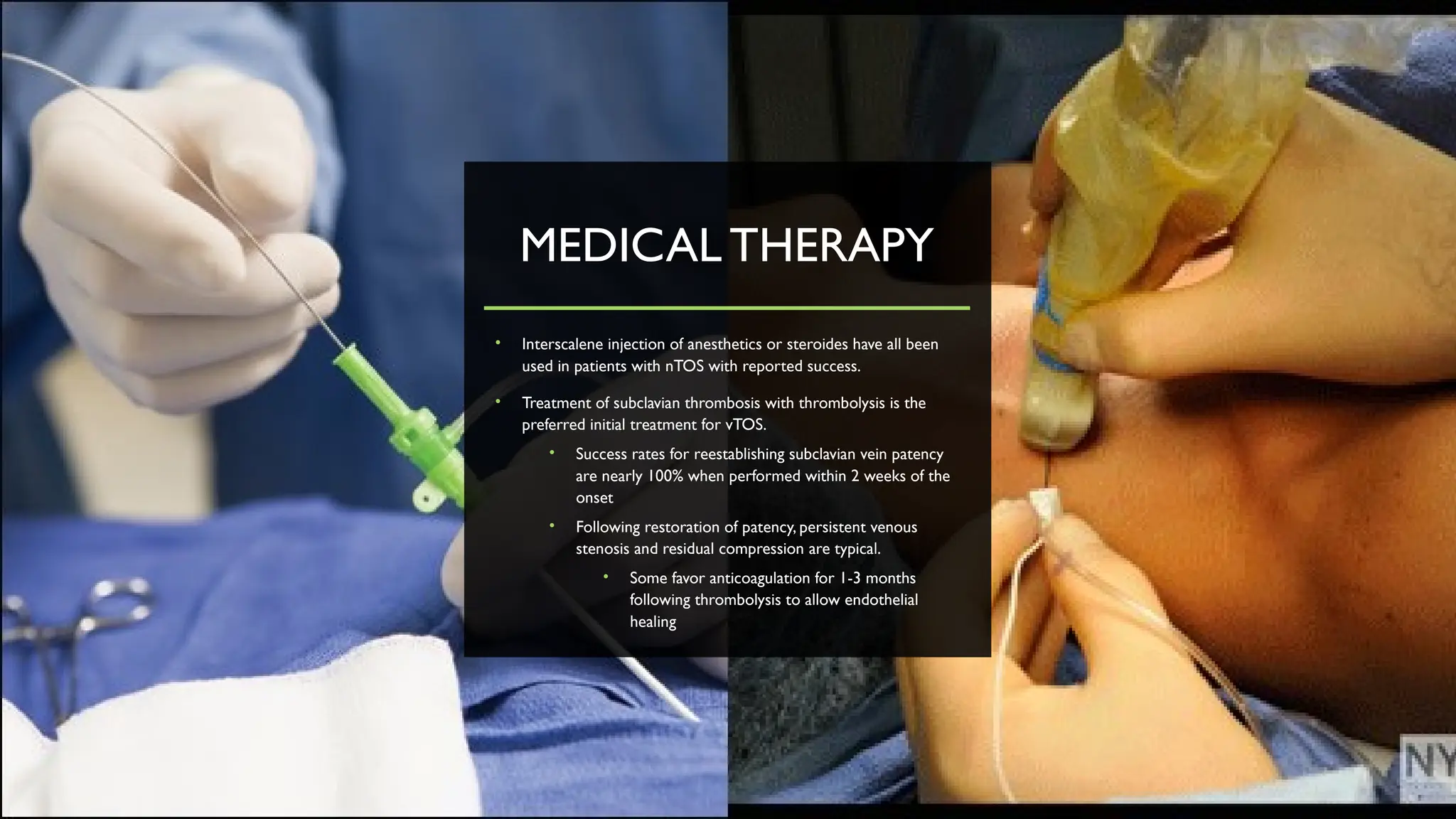 MEDICAL THERAPY
• Interscalene injection of anesthetics or steroides have all been
used in patients with nTOS with reported success.
• Treatment of subclavian thrombosis with thrombolysis is the
preferred initial treatment for vTOS.
• Success rates for reestablishing subclavian vein patency
are nearly 100% when performed within 2 weeks of the
onset
• Following restoration of patency, persistent venous
stenosis and residual compression are typical.
• Some favor anticoagulation for 1-3 months
following thrombolysis to allow endothelial
healing
 
