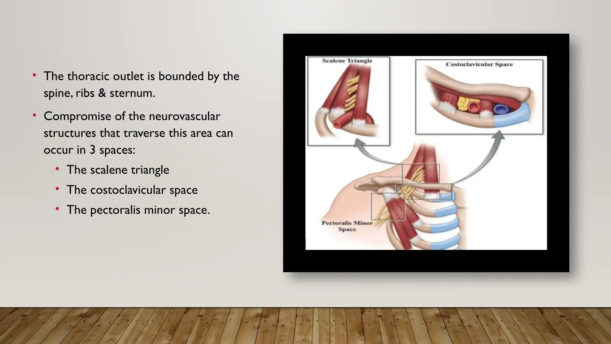 • The thoracic outlet is bounded by the
spine, ribs & sternum.
• Compromise of the neurovascular
structures that traverse this area can
occur in 3 spaces:
• The scalene triangle
• The costoclavicular space
• The pectoralis minor space.
 
