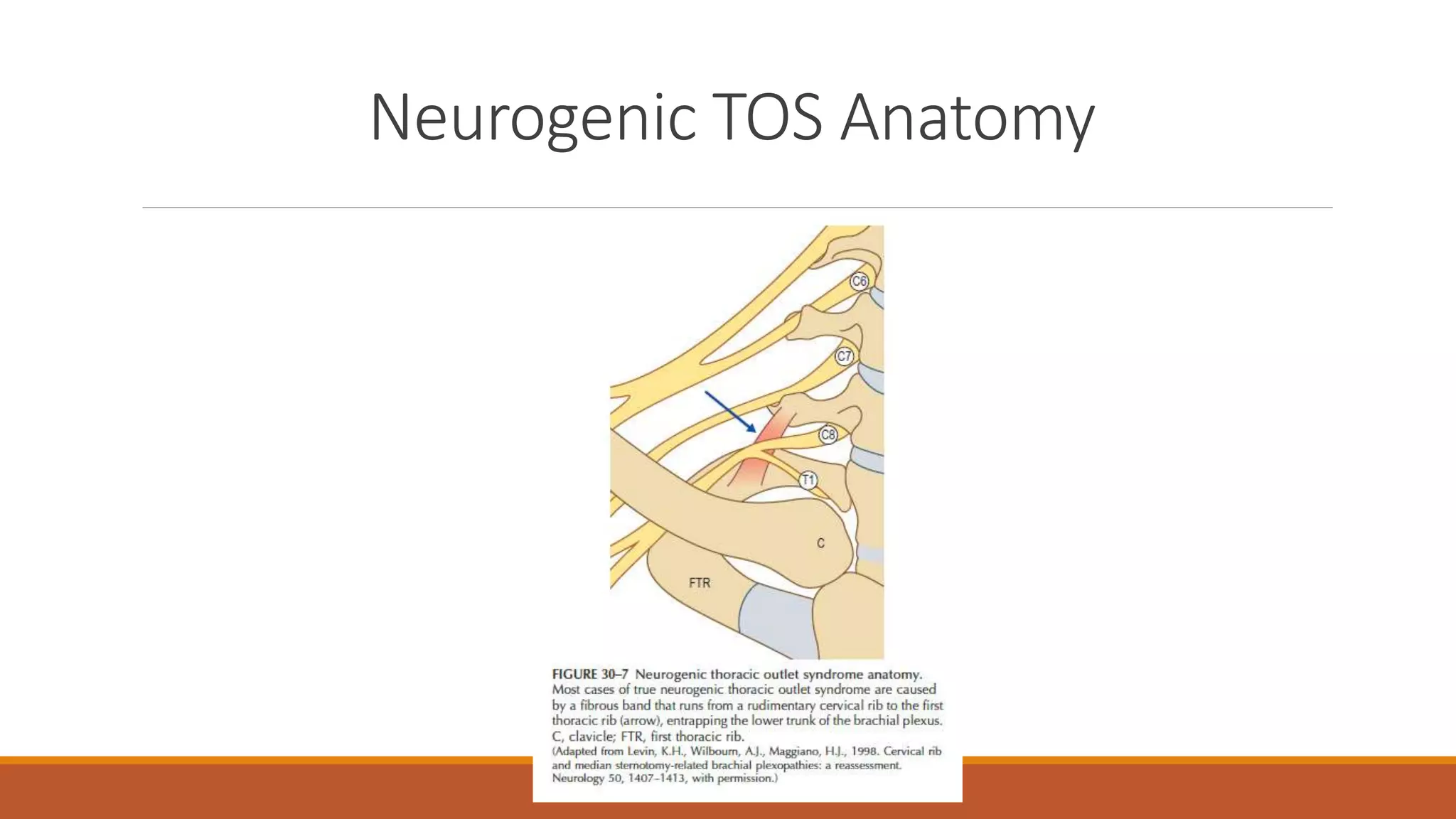 Thoracic Outlet Syndrome; Focus on Electrodiagnostic Studies | PPT
