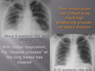 9-10 posterior ribs are
9
About 8 posterior ribs are
showing
8
With better inspiration,
the “disease process” at
the lung bases has
cleared
 