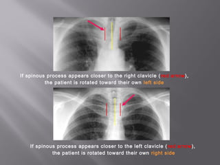 If spinous process appears closer to the right clavicle (red arrow),
the patient is rotated toward their own left side
If spinous process appears closer to the left clavicle (red arrow),
the patient is rotated toward their own right side
 