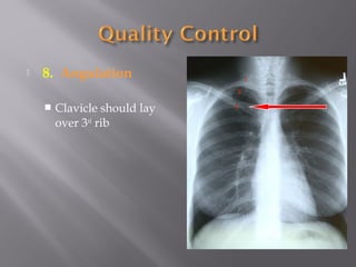  8. Angulation
 Clavicle should lay
over 3rd
rib
1
2
3
 