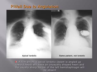 Pitfall Due to AngulationPitfall Due to Angulation
A film which is apical lordotic (beam is angled upA film which is apical lordotic (beam is angled up
toward head) will have an unusually shaped heart andtoward head) will have an unusually shaped heart and
the usually sharp border of the left hemidiaphragm willthe usually sharp border of the left hemidiaphragm will
be absentbe absent
Apical lordotic Same patient, not lordotic
 