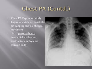  Chest PA Expiration study
 Expiratory view demonstrates
air trapping and diaphragm
movement
 Exp : pneumothorax,
interstitial shadowing,
obstructive emphysema
(foreign body)
 
