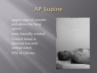  upper edge of cassette
just above the lung
apices
 arms laterally rotated
 Central beam is
directed towards
sternal notch
 FFD of 120cms.
 