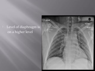  Level of diaphragm is
on a higher level
 