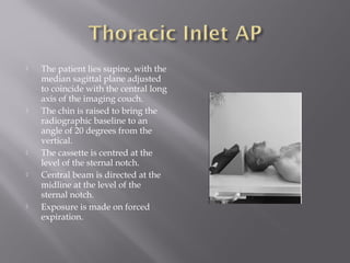  The patient lies supine, with the
median sagittal plane adjusted
to coincide with the central long
axis of the imaging couch.
 The chin is raised to bring the
radiographic baseline to an
angle of 20 degrees from the
vertical.
 The cassette is centred at the
level of the sternal notch.
 Central beam is directed at the
midline at the level of the
sternal notch.
 Exposure is made on forced
expiration.
 