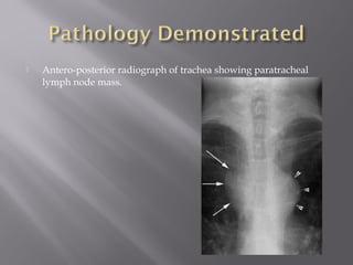  Antero-posterior radiograph of trachea showing paratracheal
lymph node mass.
 