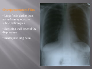 Overpenetrated Film
• Lung fields darker than
normal—may obscure
subtle pathologies
• See spine well beyond the
diaphragms
• Inadequate lung detail
 