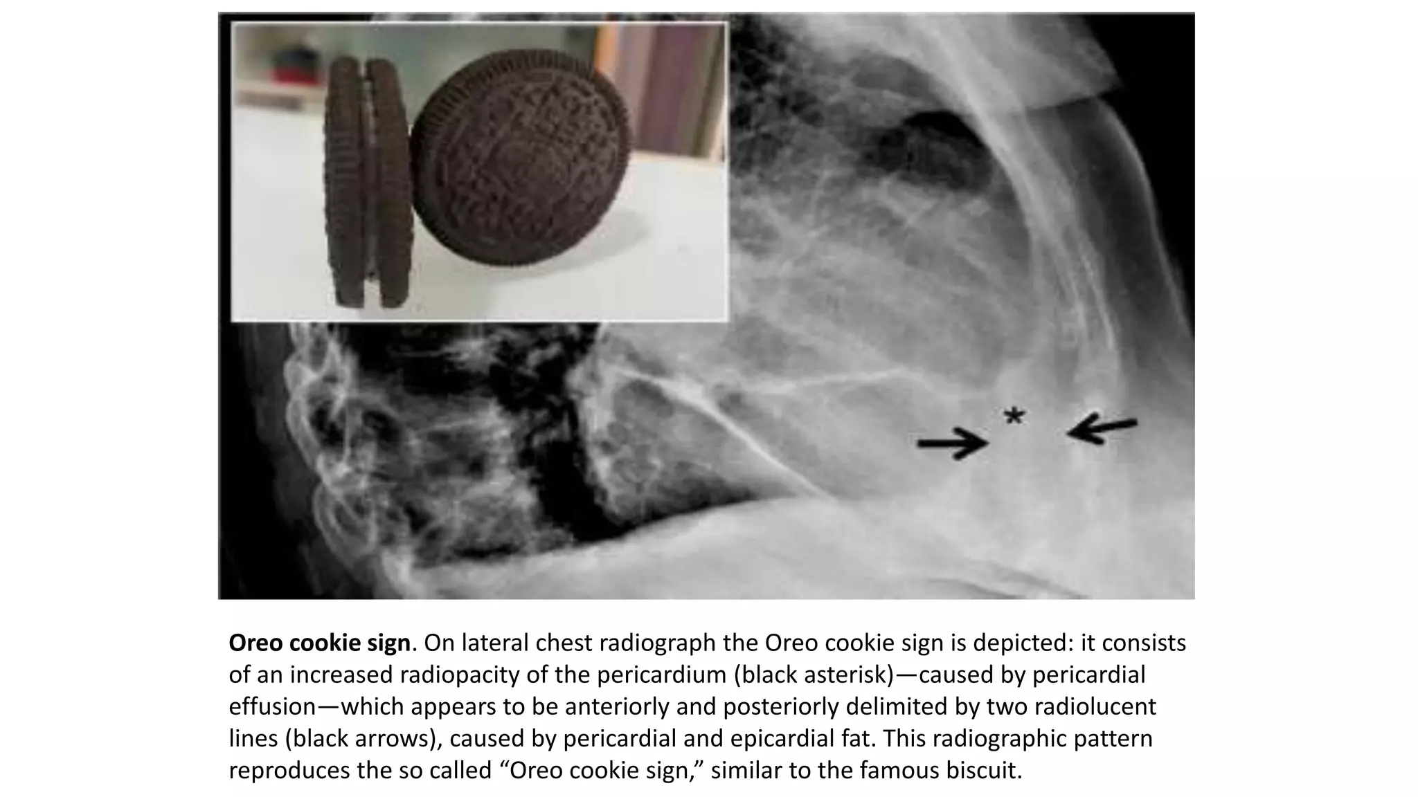 Thoracic radiological signs | PPTX