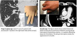 Thoracic radiological signs | PPTX