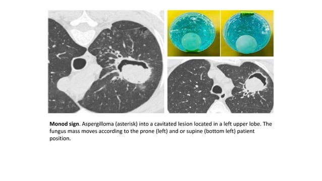 Thoracic radiological signs | PPT